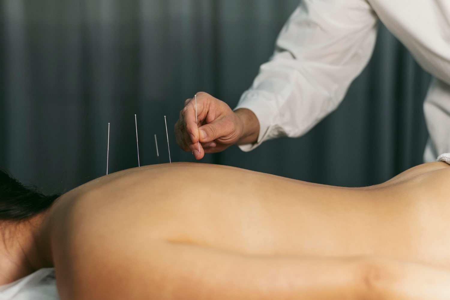 Practitioner placing dry needles along the upper back of a patient lying face down