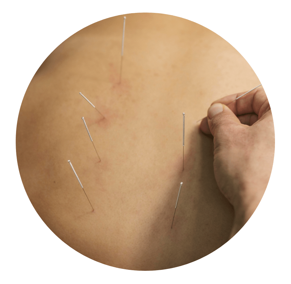 Practitioner inserting thin needles into a patient's back during dry needling