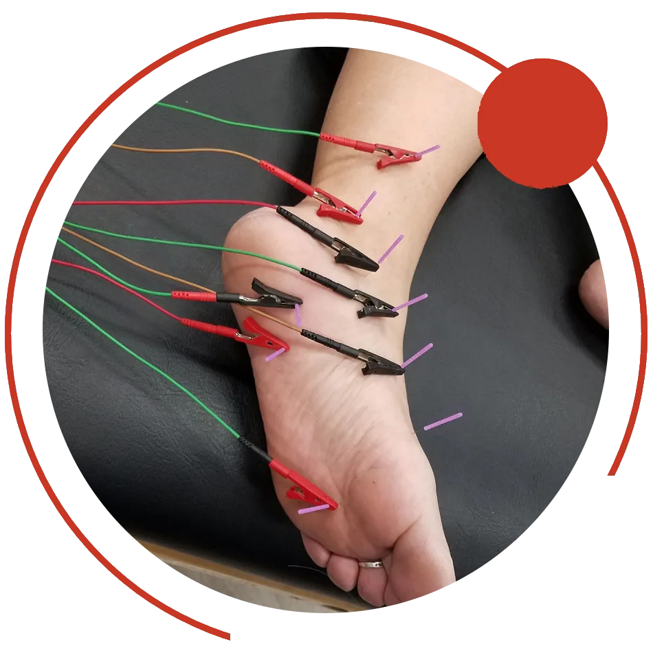 Electrical dry needling treatment on a client's ankle and foot
