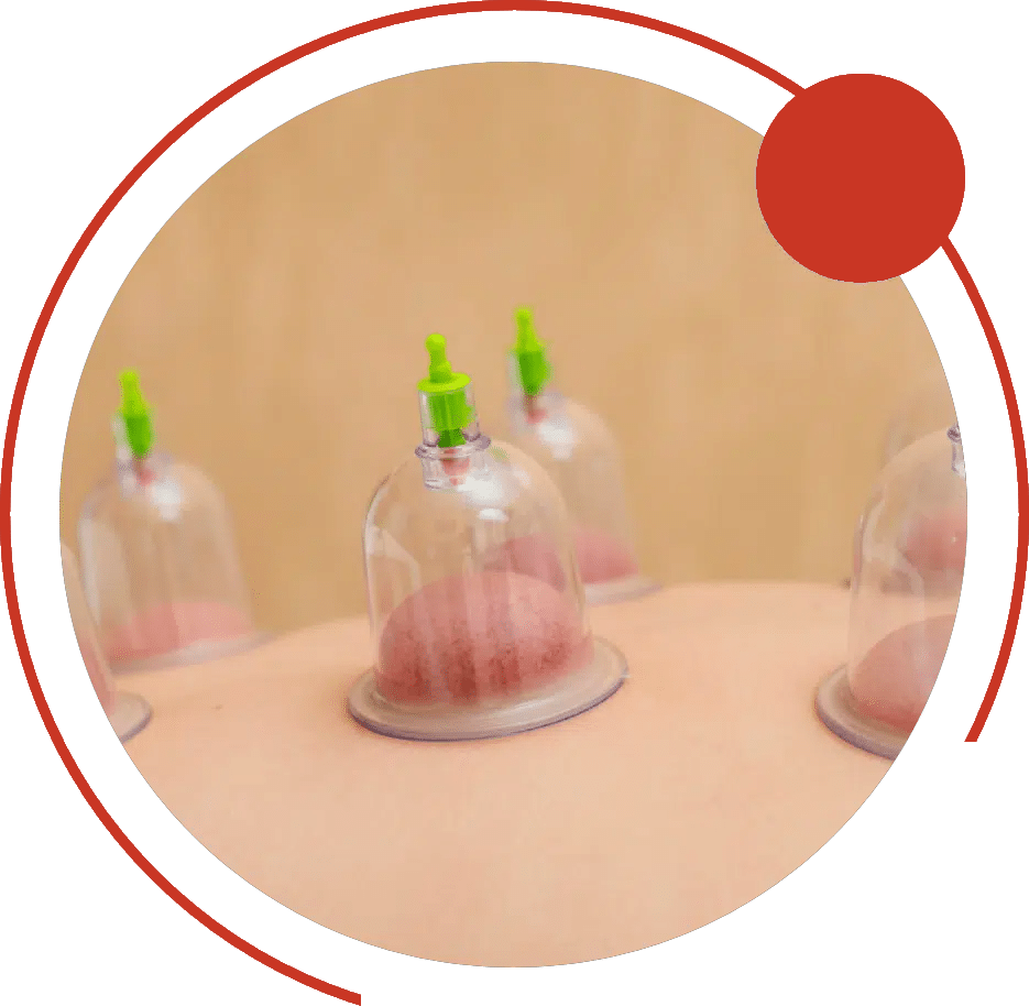 Clear suction cups placed on a patient's back during cupping therapy