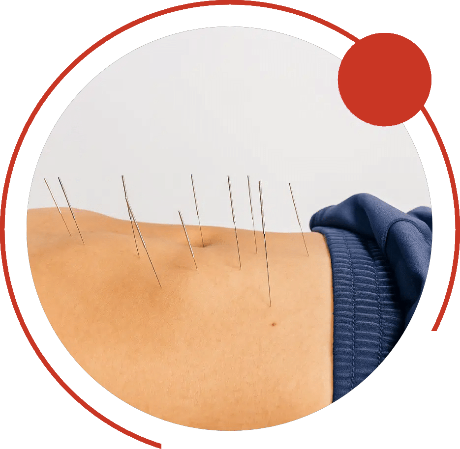 Thin dry needles inserted into the skin along a patient's abdomen